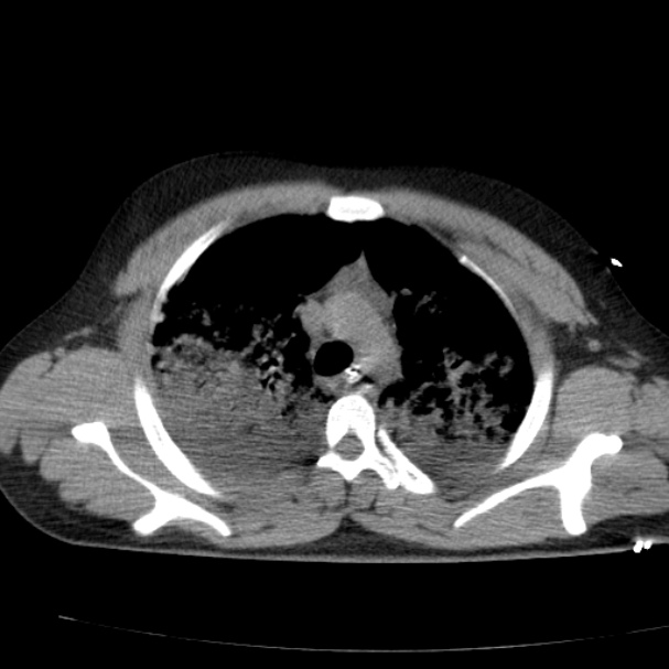 Acute aspiration pneumonitis (Radiopaedia 33605-34703 Axial non-contrast 34).jpg