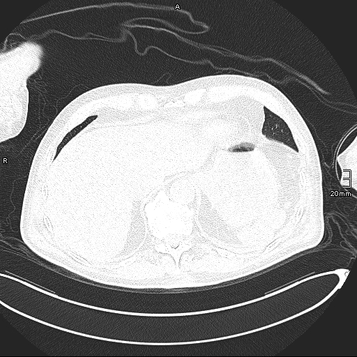 Acute aspiration pneumonitis (Radiopaedia 55642-62166 Axial lung window 135).jpg