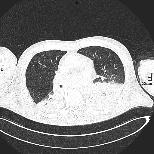 Acute aspiration pneumonitis (Radiopaedia 55642-62166 Axial lung window 82).jpg