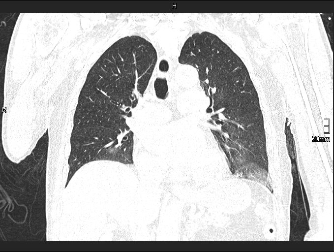 Acute aspiration pneumonitis (Radiopaedia 55642-62166 Coronal lung window 52).jpg