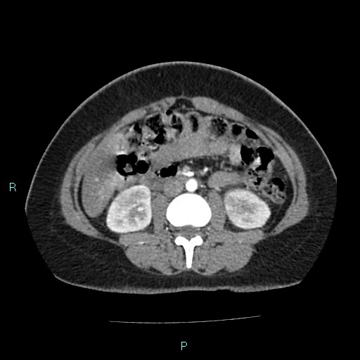 Acute bilateral pyelonephritis (Radiopaedia 37146-38881 Axial C+ arterial phase 96).jpg