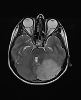 File:Acute cerebellar ataxia (Radiopaedia 61487-69446 Axial T2 7).jpg