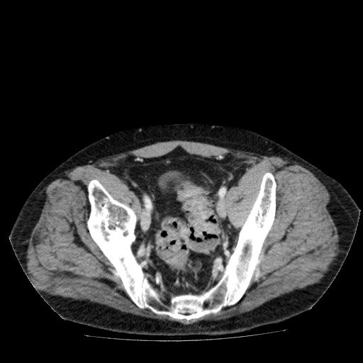 Acute cholecystitis and incidental left sided IVC (Radiopaedia 49352-54459 Axial C+ portal venous phase 131).jpg
