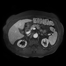 File:Acute cholecystitis complicated by pylephlebitis (Radiopaedia 65782-74915 Axial arterioportal phase T1 C+ fat sat 62).jpg