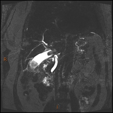 File:Acute cholecystitis with gallbladder neck calculus (Radiopaedia 42795-45971 Coronal Turbo spin echo 18).jpg