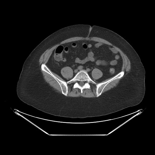Acute cholecystitis with tensile fundus sign (Radiopaedia 71394-81723 Axial non-contrast 76).jpg
