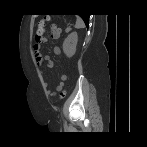 Acute cholecystitis with tensile fundus sign (Radiopaedia 71394-81723 Sagittal non-contrast 122).jpg