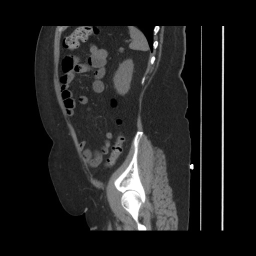File:Acute cholecystitis with tensile fundus sign (Radiopaedia 71394-81723 Sagittal non-contrast 126).jpg