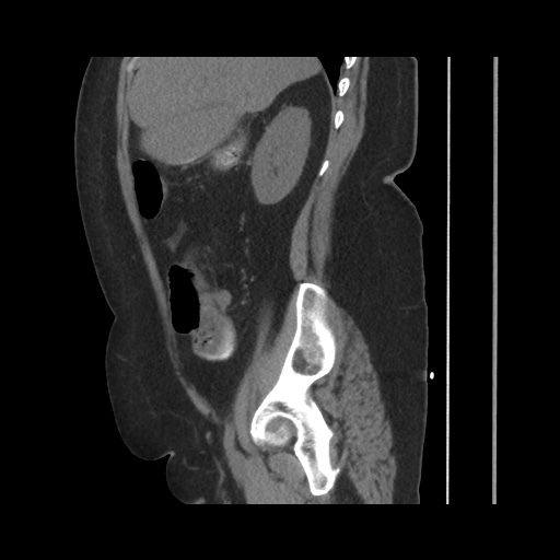 File:Acute cholecystitis with tensile fundus sign (Radiopaedia 71394-81723 Sagittal non-contrast 62).jpg
