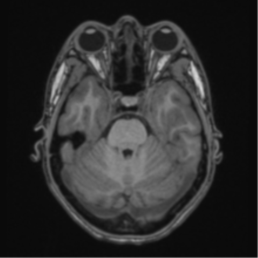 Acute disseminated encephalomyelitis (ADEM) (Radiopaedia 65319-74349 Axial T1 17).png