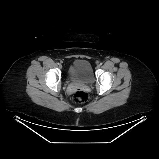 Acute diverticulitis - transverse colon (Radiopaedia 87063-103327 Axial C+ portal venous phase 155).jpg