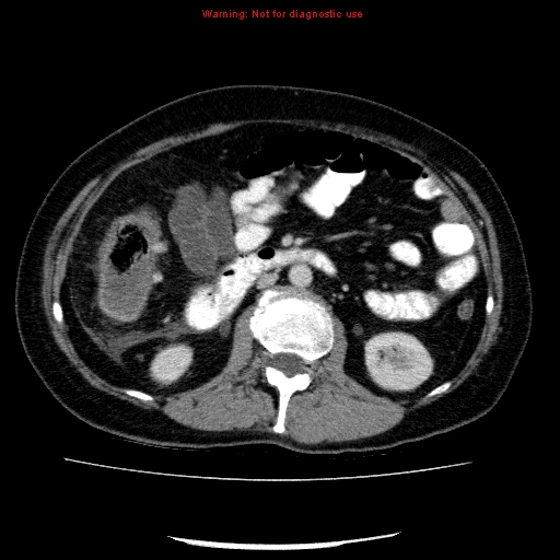 File:Acute gangrenous cholecystitis (Radiopaedia 10123-10661 Axial C+ portal venous phase 47).jpg