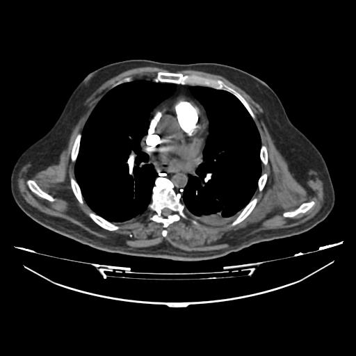 Acute heart failure (CT) (Radiopaedia 79835-93075 Axial C+ arterial phase 16).jpg