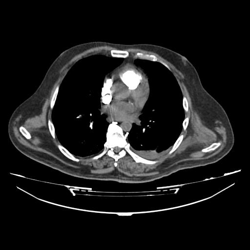 File:Acute heart failure (CT) (Radiopaedia 79835-93075 Axial C+ arterial phase 19).jpg