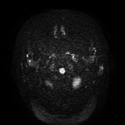 Acute internal carotid artery dissection (Radiopaedia 53541-59632 Axial DWI 2).jpg