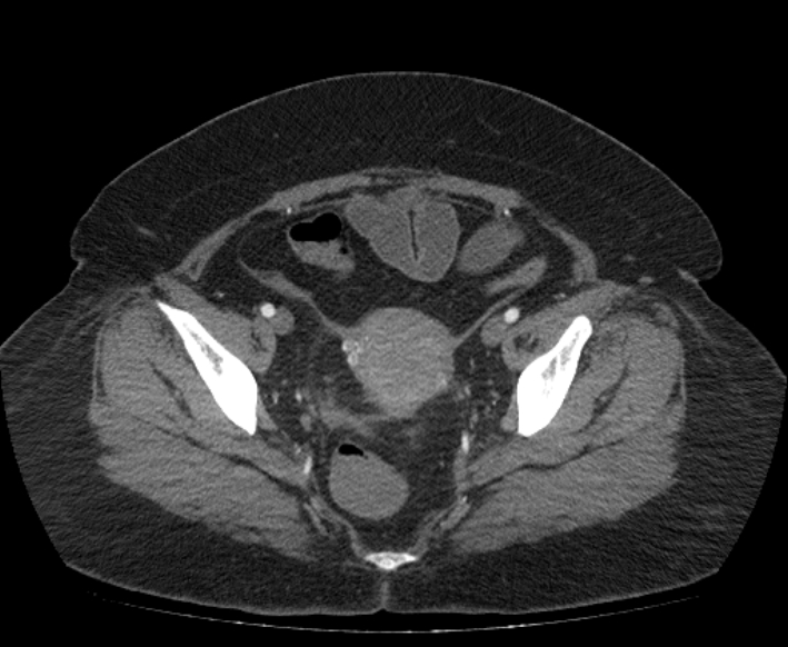 Acute mesenteric ischemia (Radiopaedia 80029-93316 Axial C+ arterial phase 116).jpg