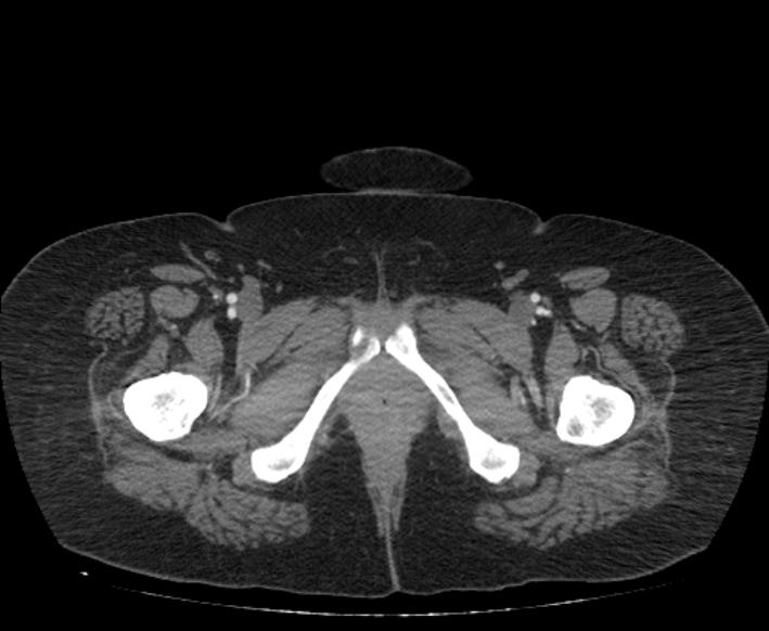 Acute mesenteric ischemia (Radiopaedia 80029-93316 Axial C+ arterial phase 143).jpg