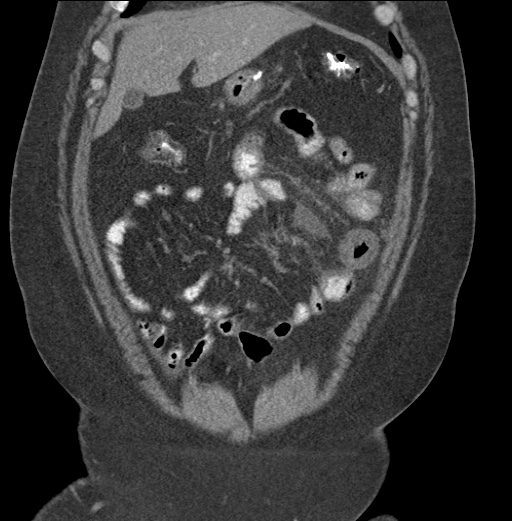 Acute mesenteric venous ischemia (Radiopaedia 46041-50383 Coronal C+ portal venous phase 25).jpg