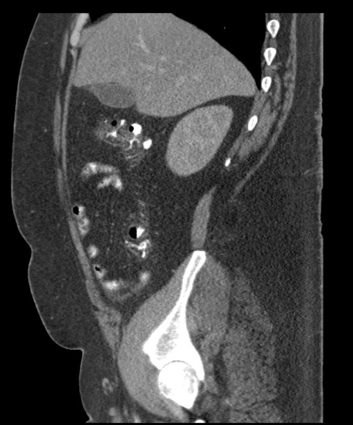 Acute mesenteric venous ischemia (Radiopaedia 46041-50383 Sagittal C+ portal venous phase 29).jpg