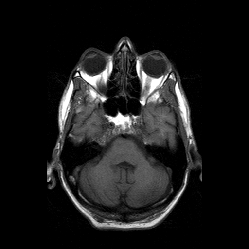 File:Acute necrotizing toxoplasma encephalitis (Radiopaedia 10683-11149 Axial T1 14).jpg