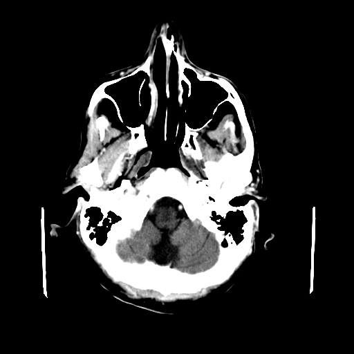 File:Acute necrotizing toxoplasma encephalitis (Radiopaedia 10683-11150 C+ arterial phase 28).jpg