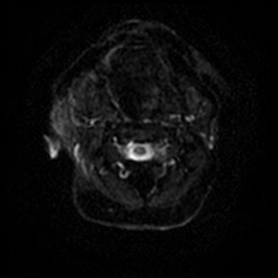 Acute otitis externa (Radiopaedia 57296-64236 Axial DWI 44).jpg