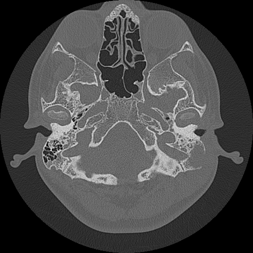 Acute otomastoiditis and Bezold abscess (Radiopaedia 88184-104786 Axial bone window 24).jpg