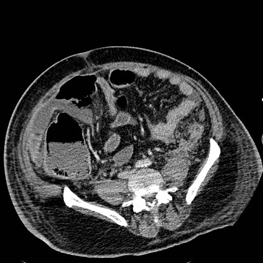 File:Acute pancreatic necrosis (Radiopaedia 13560-18501 Axial C+ portal venous phase 96).jpg