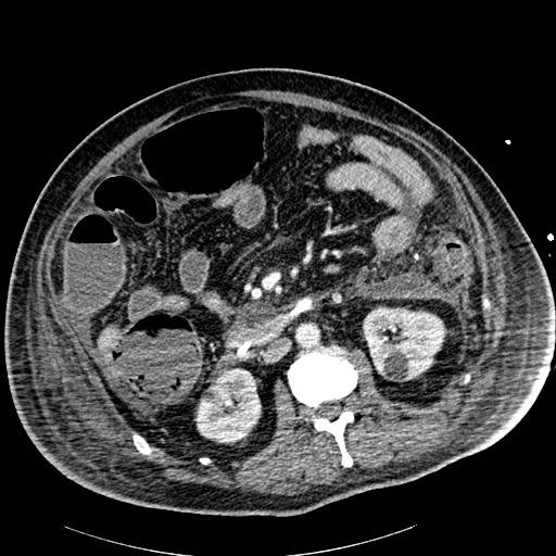 Acute pancreatic necrosis (Radiopaedia 13560-18502 Axial C+ portal venous phase 48).jpg