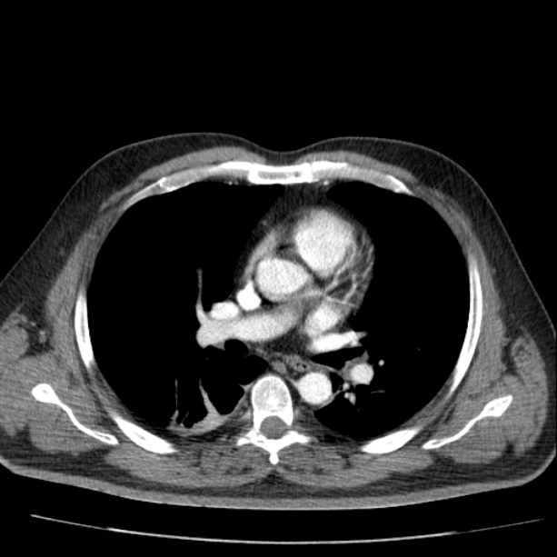 Acute pancreatitis (Radiopaedia 26663-26813 Axial C+ arterial phase 2).jpg