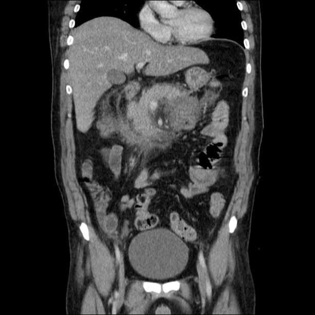 Acute pancreatitis (Radiopaedia 26663-26813 Coronal C+ portal venous phase 27).jpg