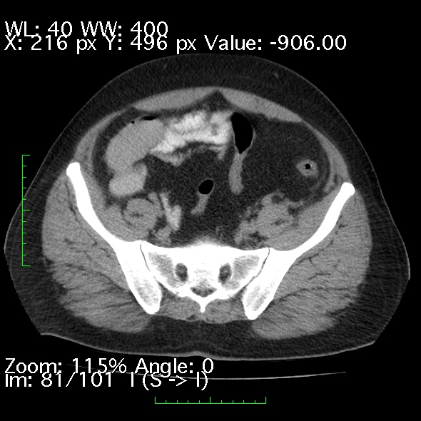Acute pancreatitis (Radiopaedia 34043-35276 Axial non-contrast 81).jpg