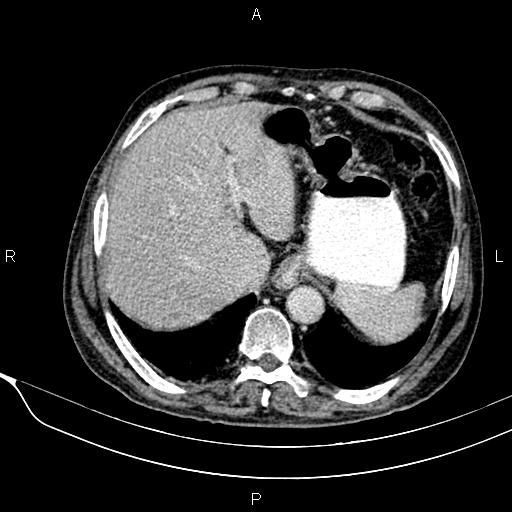 Acute pancreatitis (Radiopaedia 85146-100701 Axial C+ portal venous phase 16).jpg