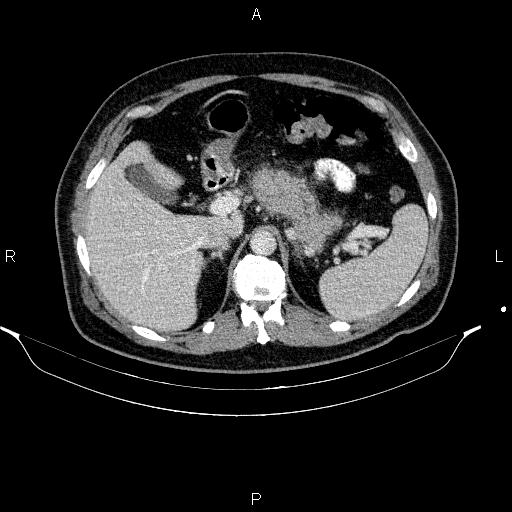 File:Acute pancreatitis (Radiopaedia 85390-101010 Axial C+ portal venous phase 29).jpg