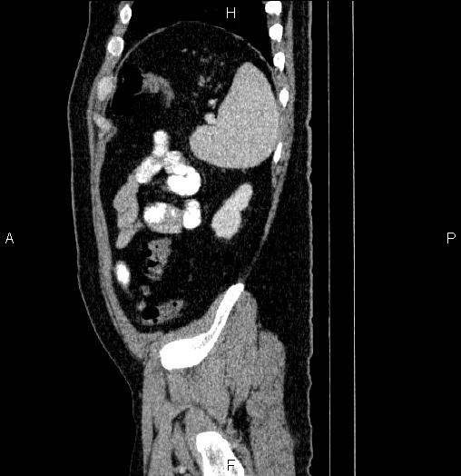 File:Acute pancreatitis (Radiopaedia 85390-101010 Sagittal C+ portal venous phase 89).jpg