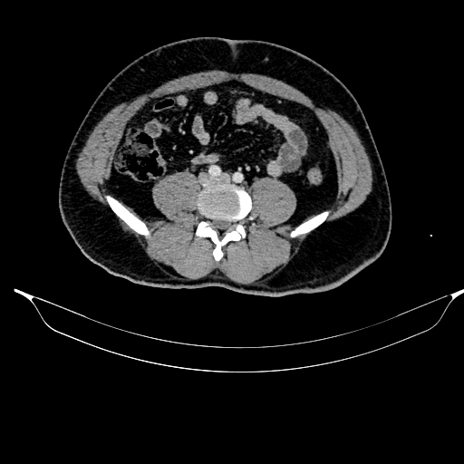 File:Acute pancreatitis (Radiopaedia 87428-103757 Axial C+ portal venous phase 65).jpg