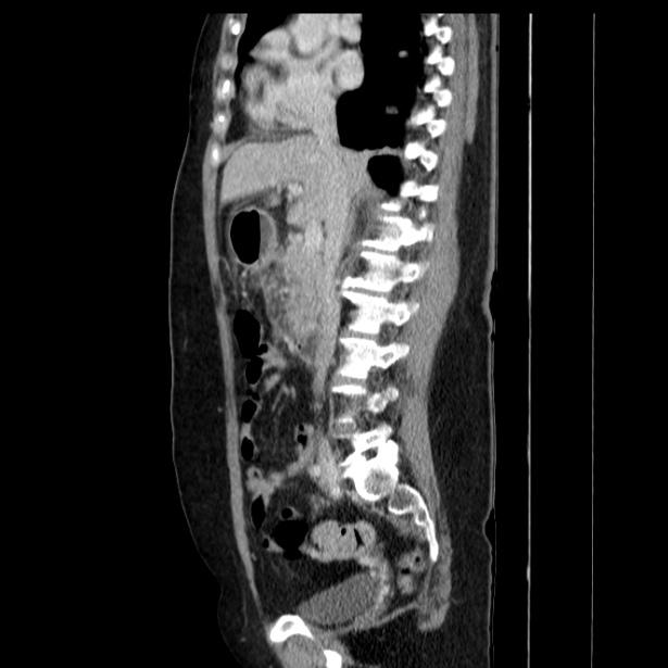 Acute pancreatitis - Balthazar C (Radiopaedia 26569-26714 Sagittal C+ portal venous phase 31).jpg