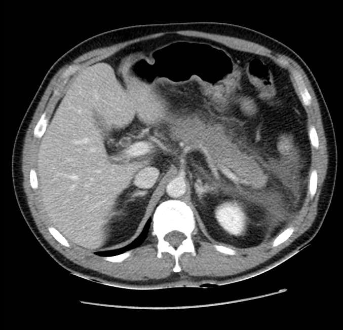 Acute pancreatitis - Balthazar E (Radiopaedia 23080-23110 Axial C+ portal venous phase 19).jpg