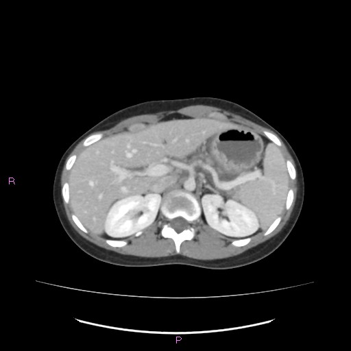File:Acute pancreatitis secondary to stone at minor papilla and pancreatic divisum (Radiopaedia 76570-88333 Axial C+ portal venous phase 22).jpg
