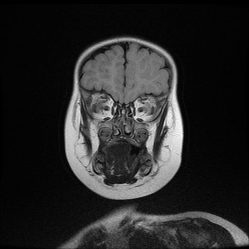 File:Acute phase of hemiconvulsion-hemiplegia epilepsy syndrome (Radiopaedia 29309-29745 Coronal FLAIR 5).jpg
