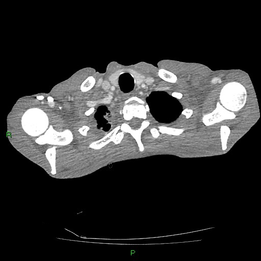 File:Acute right lung abscess (Radiopaedia 34806-36258 Axial C+ arterial phase 10).jpg