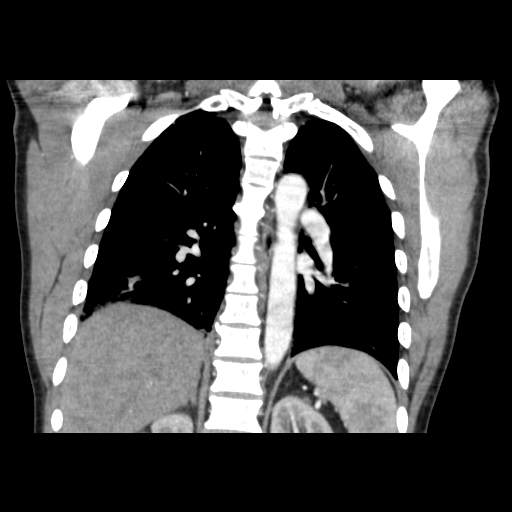 Acute segmental pulmonary emboli and pulmonary infarction (Radiopaedia 62264-70444 Coronal C+ CTPA 36).jpg