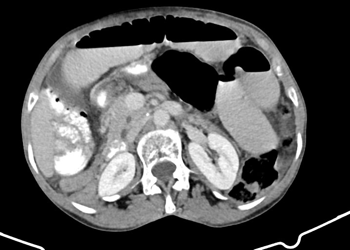 Acute small bowel (ileal) volvulus (Radiopaedia 71740-82139 Axial C+ portal venous phase 83).jpg