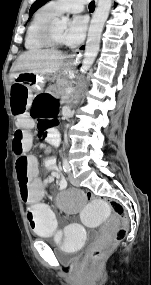 Acute small bowel (ileal) volvulus (Radiopaedia 71740-82139 Sagittal C+ portal venous phase 80).jpg