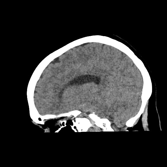 Acute subarachnoid hemorrhage and accessory anterior cerebral artery (Radiopaedia 69231-79008 Sagittal non-contrast 26).jpg