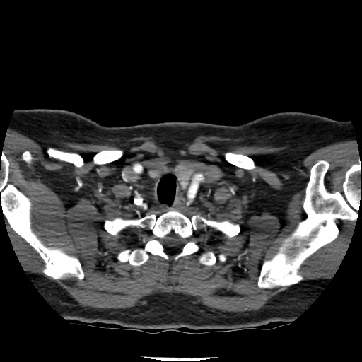 Acute subarachnoid hemorrhage and accessory anterior cerebral artery (Radiopaedia 69231-79009 Axial C+ arterial phase 29).jpg