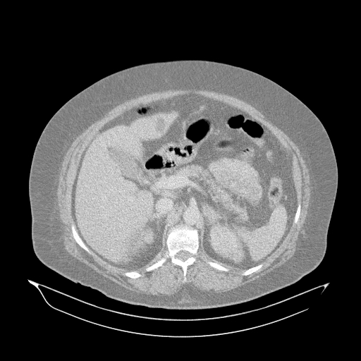 File:Acute superior mesenteric artery occlusion (Radiopaedia 51288-56960 Axial lung window 11).jpg