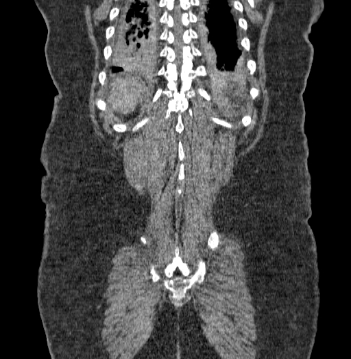 Acute superior mesenteric artery occlusion (Radiopaedia 51288-56960 Coronal C+ portal venous phase 66).jpg