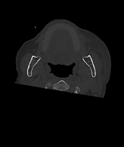 Acute traumatic subdural hematoma (Radiopaedia 82921-97257 Axial bone window 115).jpg