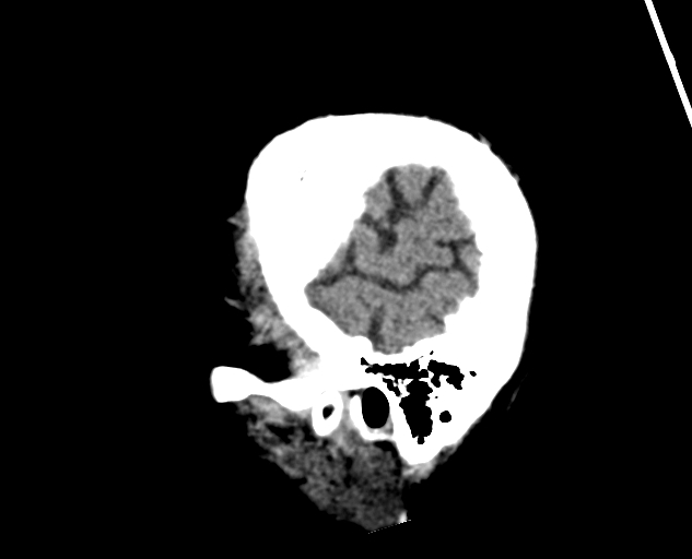 Acute traumatic subdural hematoma (Radiopaedia 82921-97257 Sagittal non-contrast 63).jpg